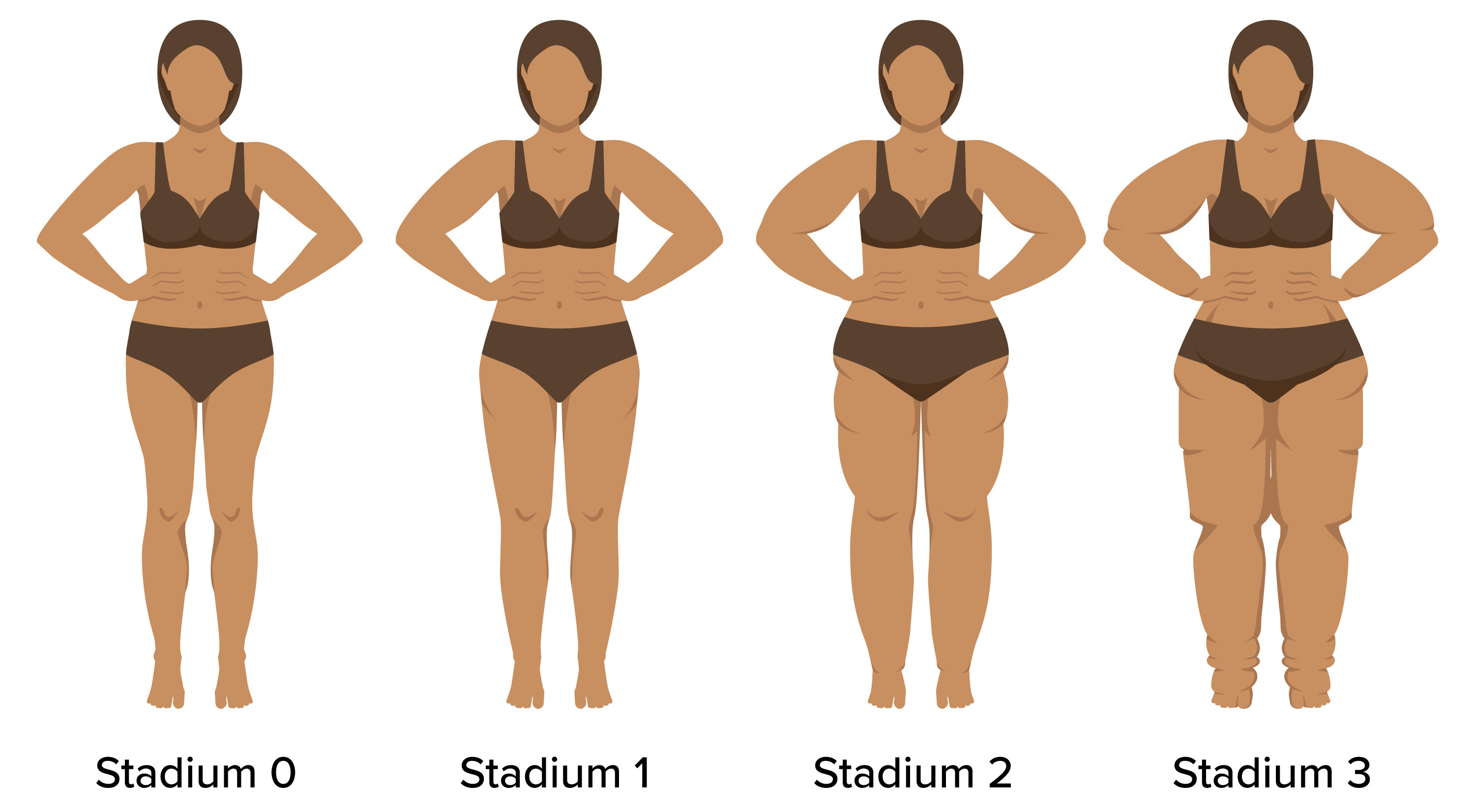 Lipödem-Stadien: Erklärung von Stadium 1 - Stadium 3